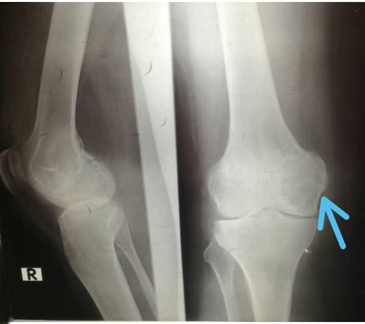 Primary cystic echinococcosis presented as prolonged disabling knee